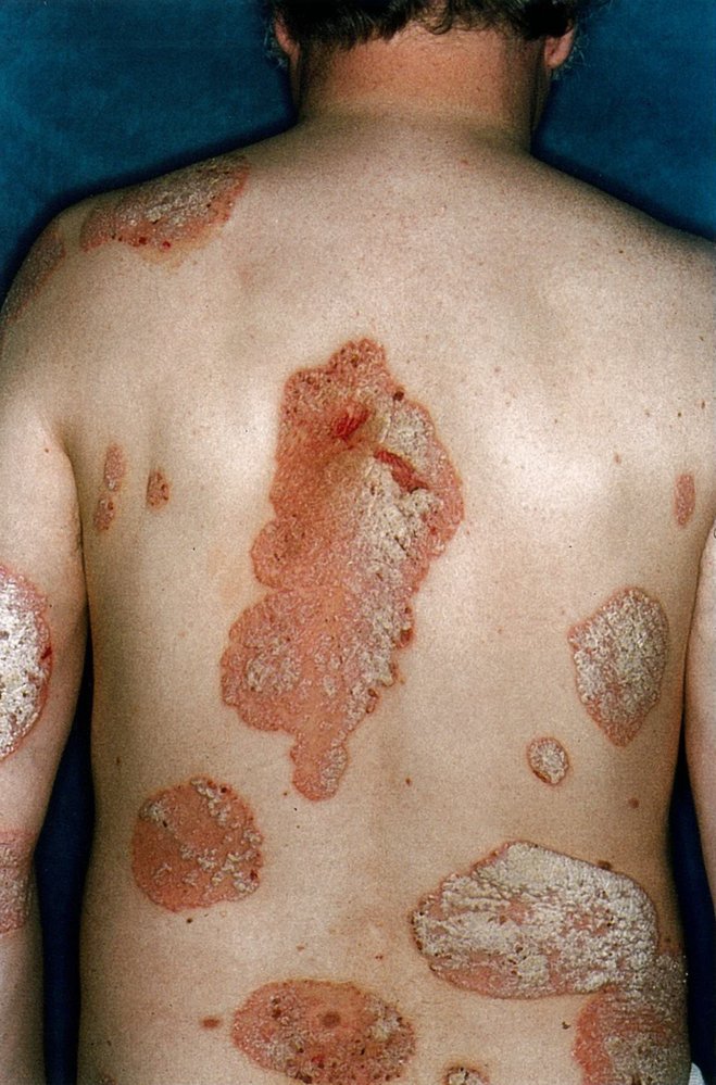 Plaque psoriasis