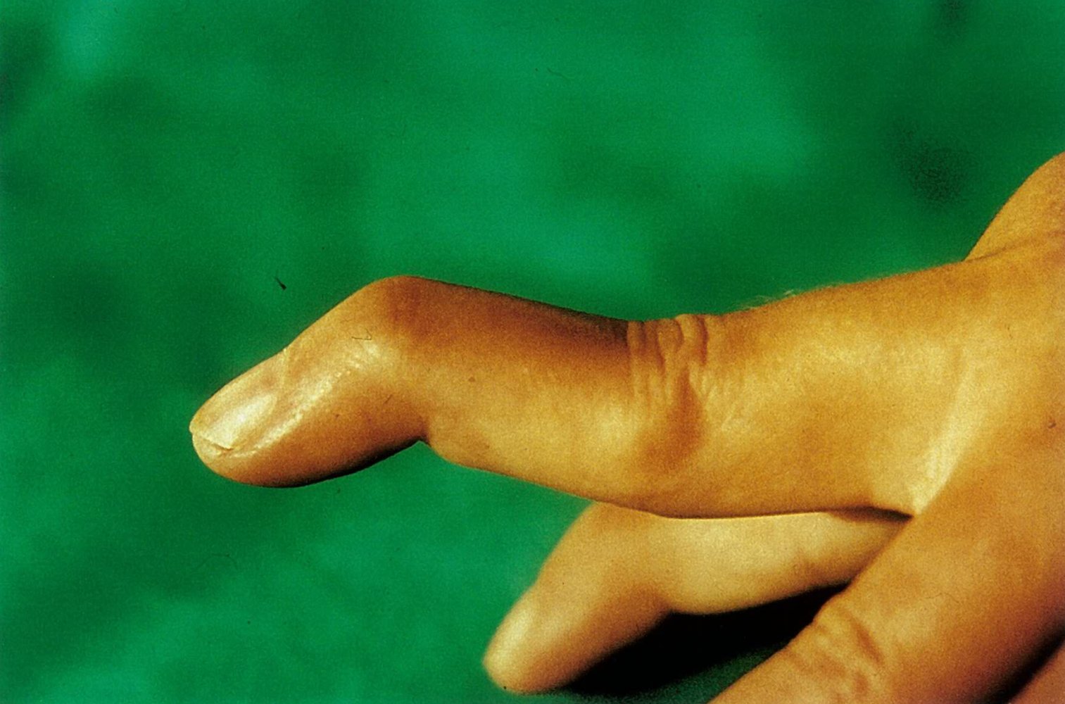 Swan neck deformity