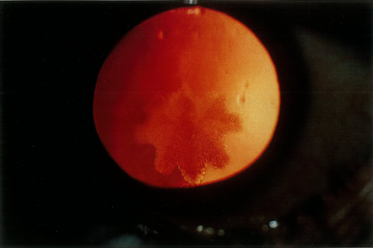 Traumatic cataract (contusion cataract)