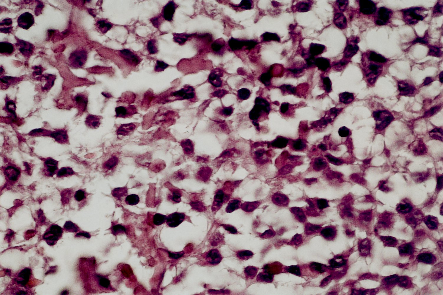 Osteosarcoma