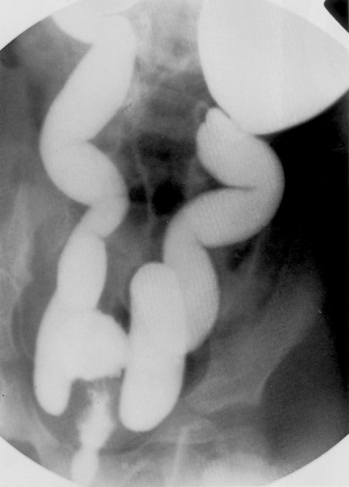 Refluxing megaureter in a voiding cystourethrogram (2/2)