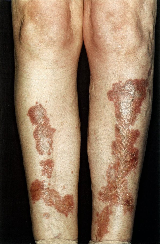 Necrobiosis lipoidica