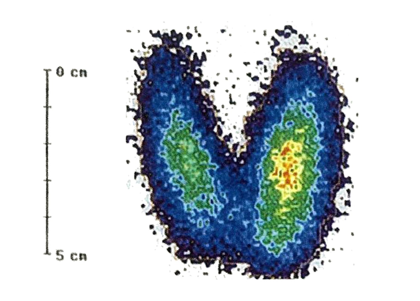 Hyperthyroidism in Graves disease