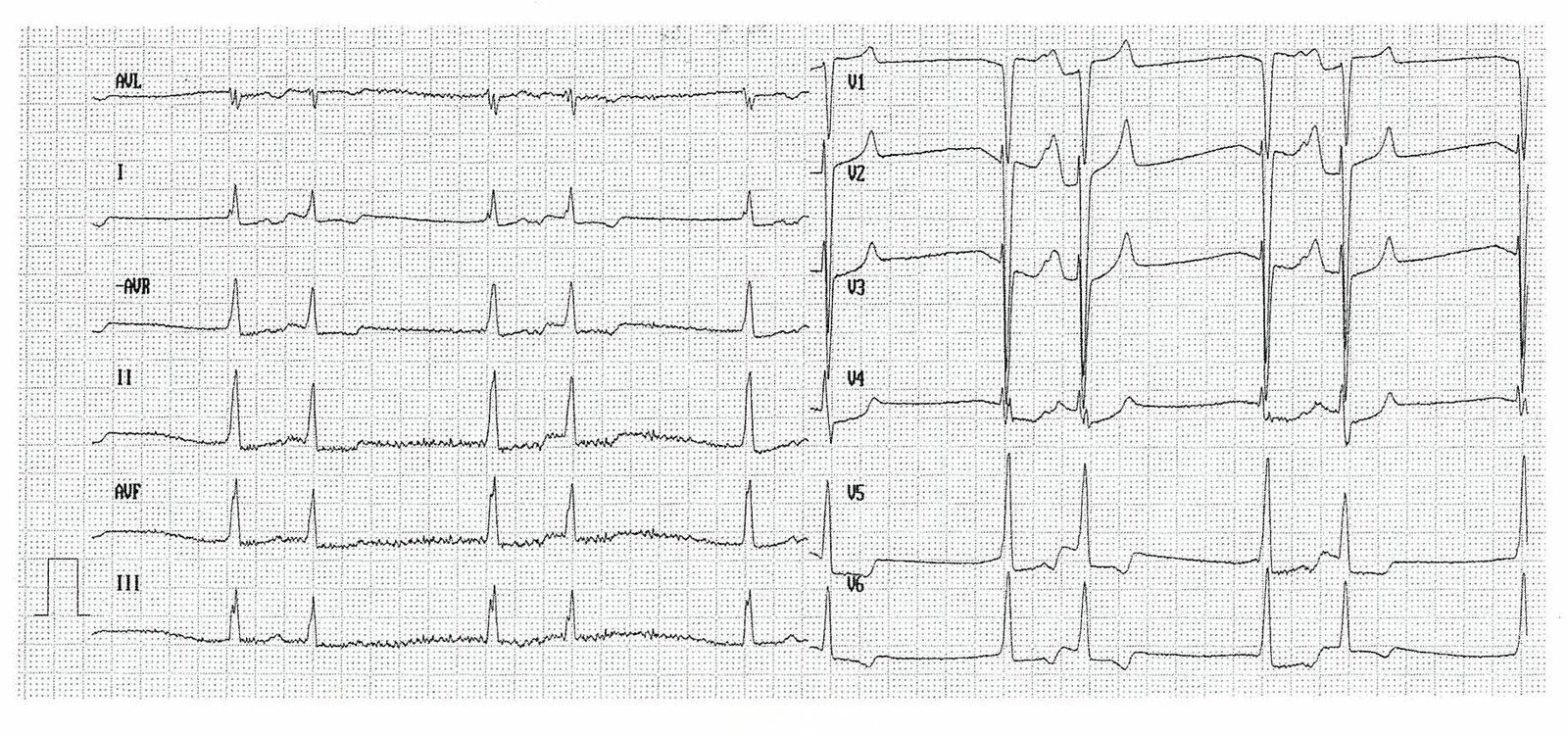 Bigeminy and left ventricular hypertrophy
