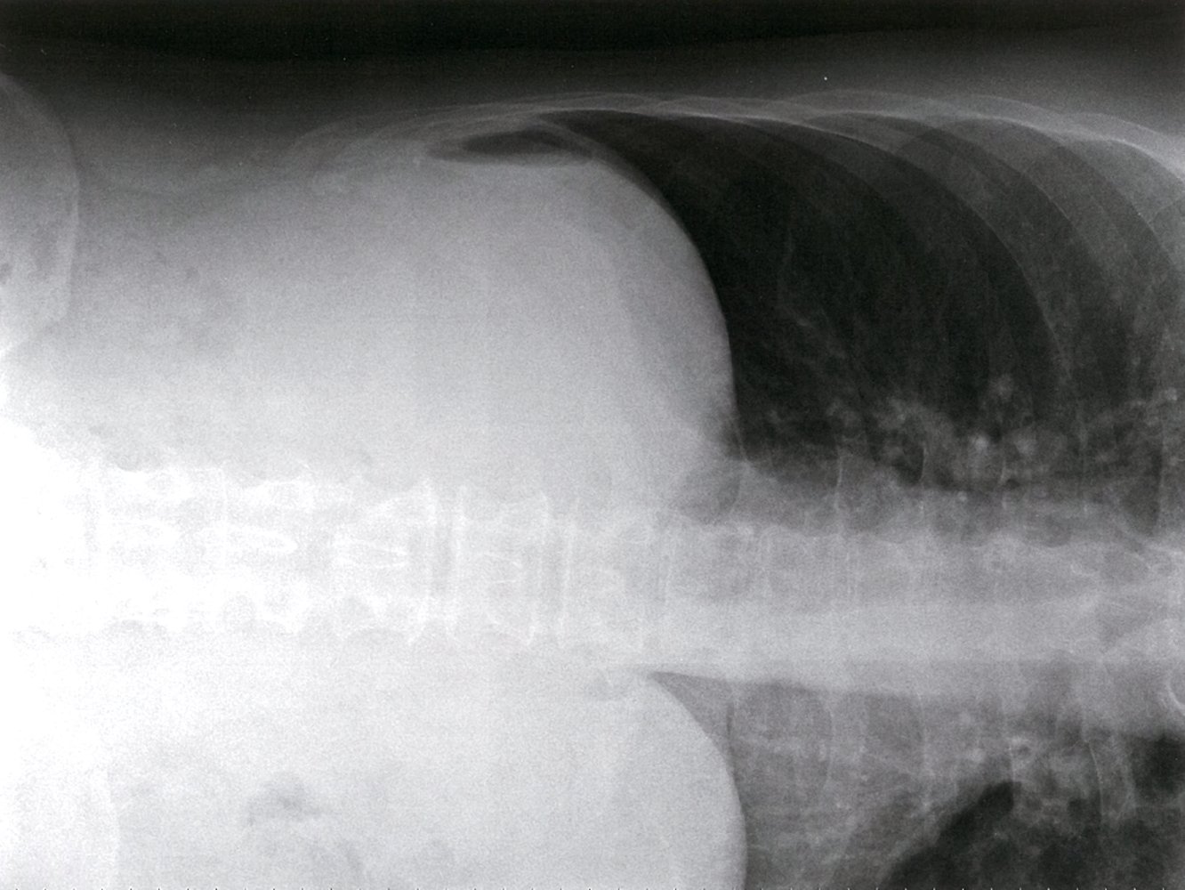 Free intraperitoneal air