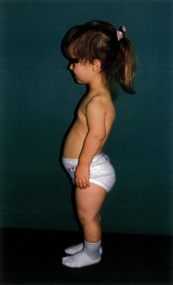Achondroplasia
