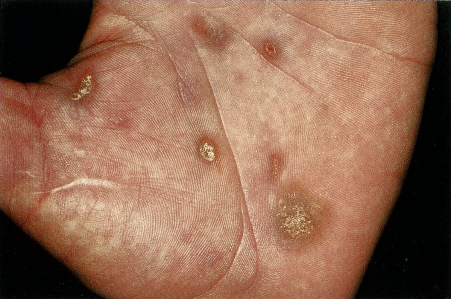 Maculopapular rash in secondary syphilis