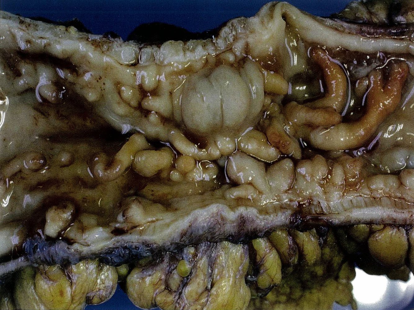 Colon in Crohn disease