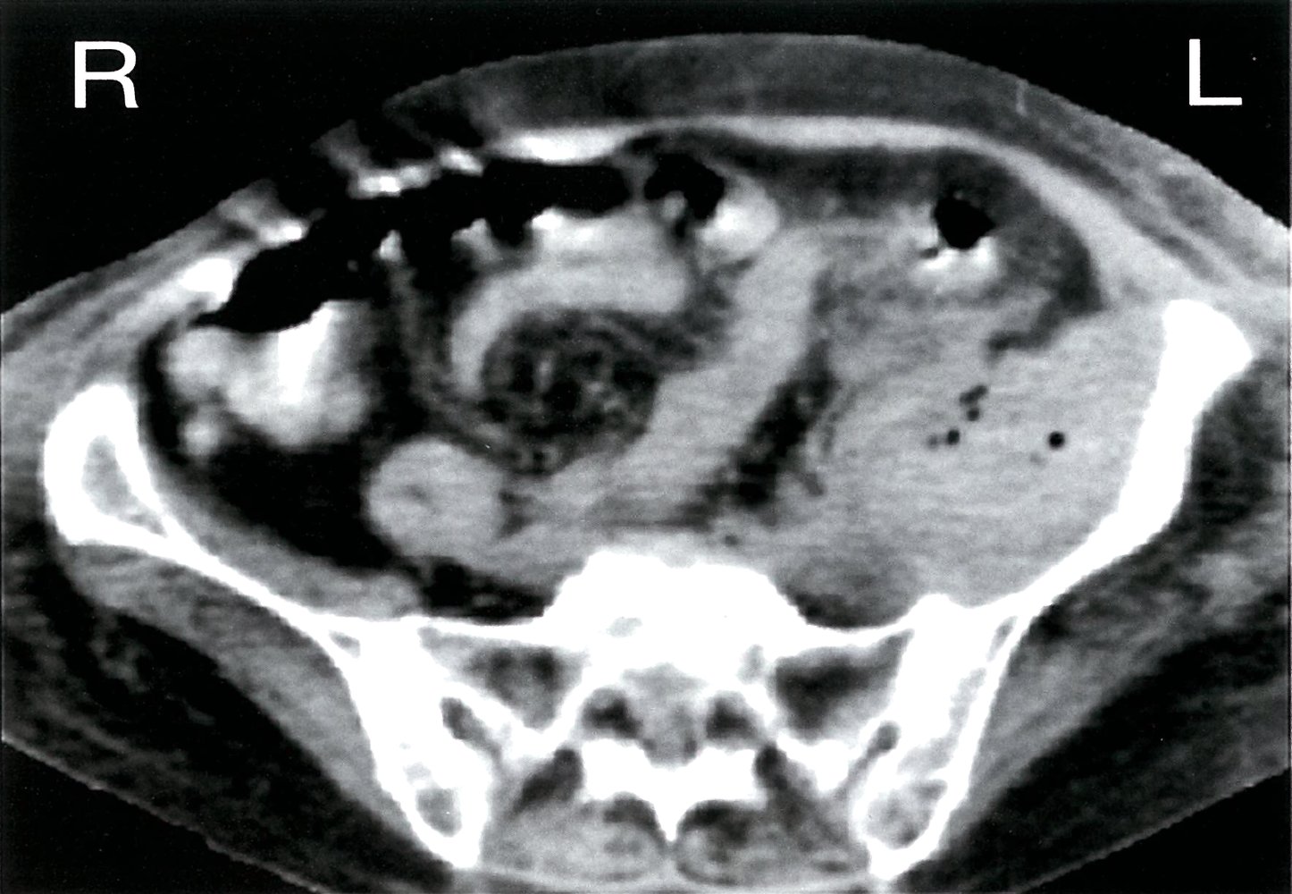 Suspected abscess with gas inclusions in the left lower abdomen