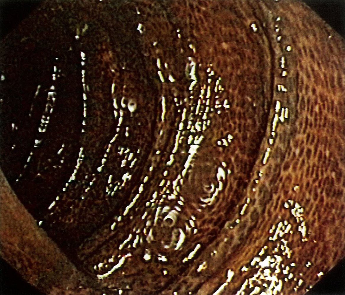 Melanosis coli