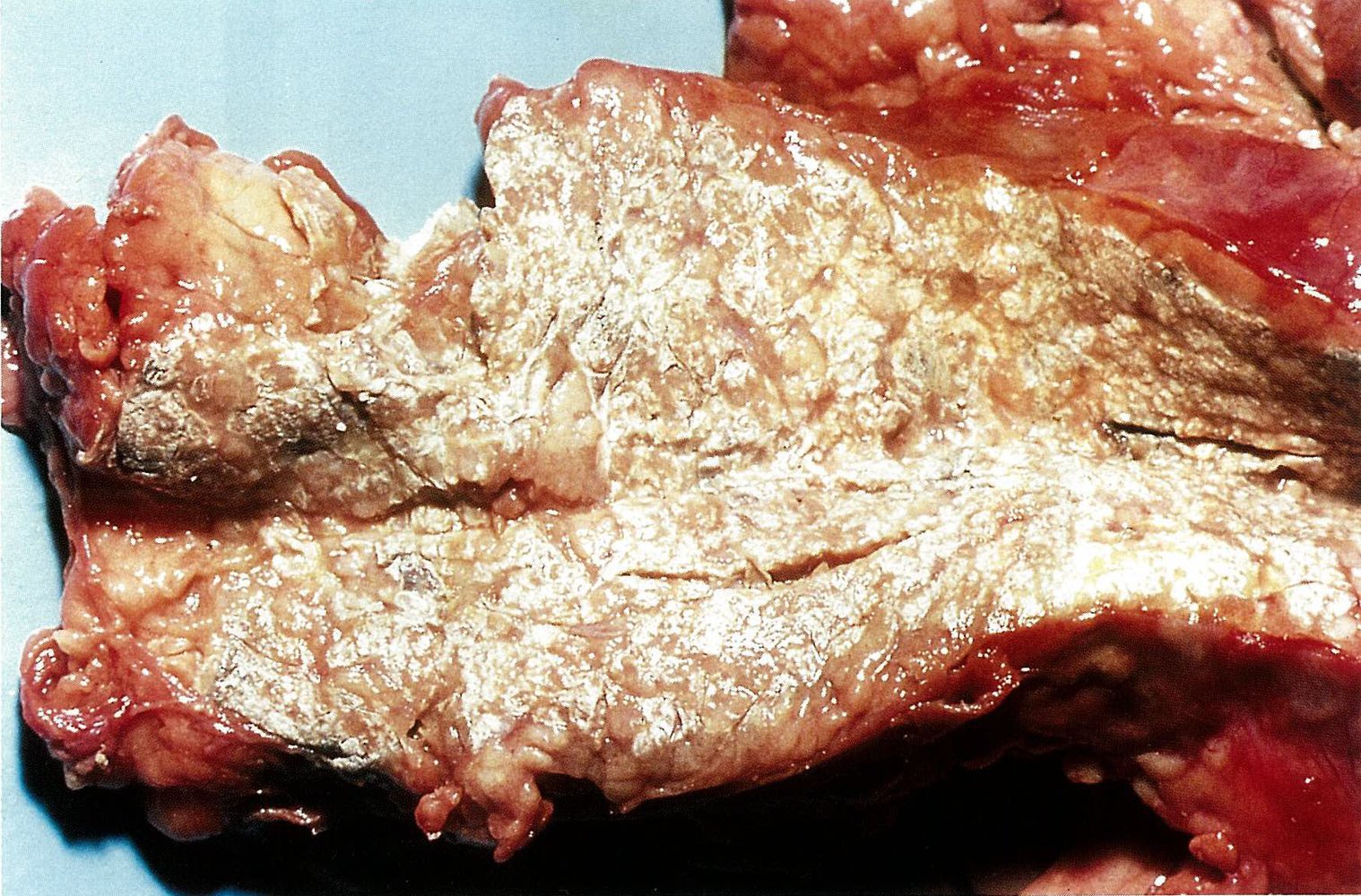 Fulminant acute pancreatitis