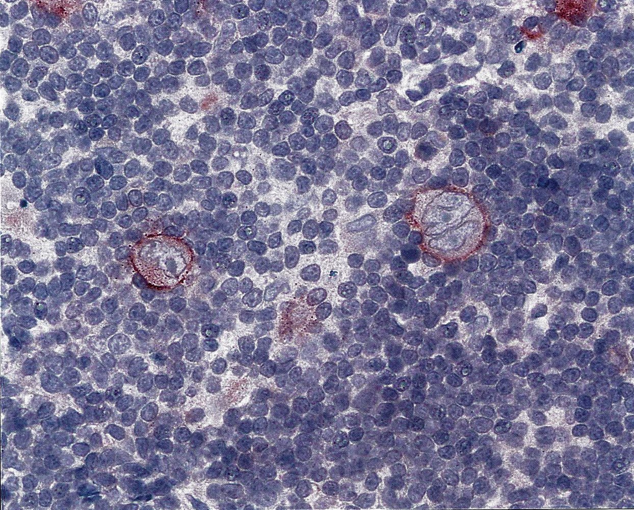 Hodgkin lymphoma