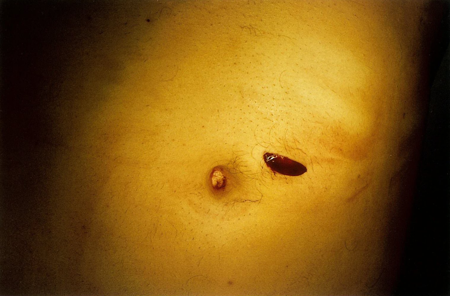 Stab wound in the left paraumbilical region