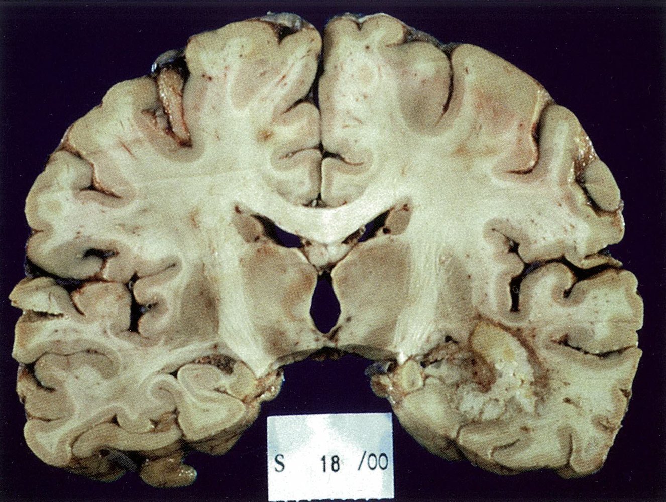 Glioblastoma in the temporal lobe