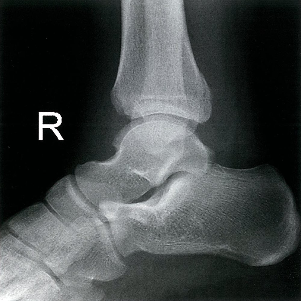 Avulsion fracture of the posterior tibial margin (Volkmann's triangle)