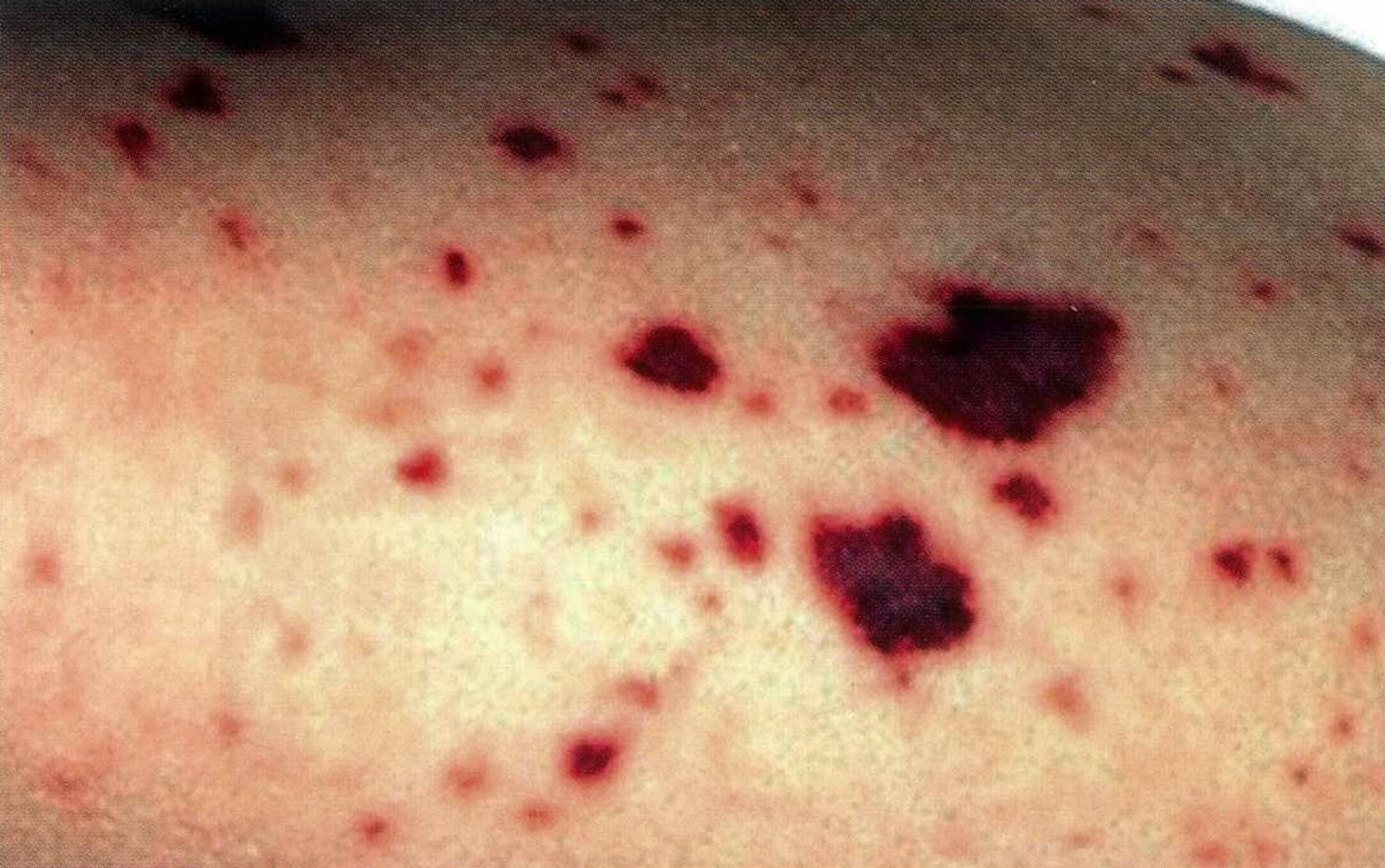 Purpura in Waterhouse-Friderichsen syndrome
