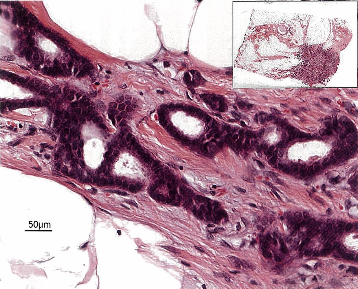 Invasive breast carcinoma of no special type (invasive ductal carcinoma) 3/3