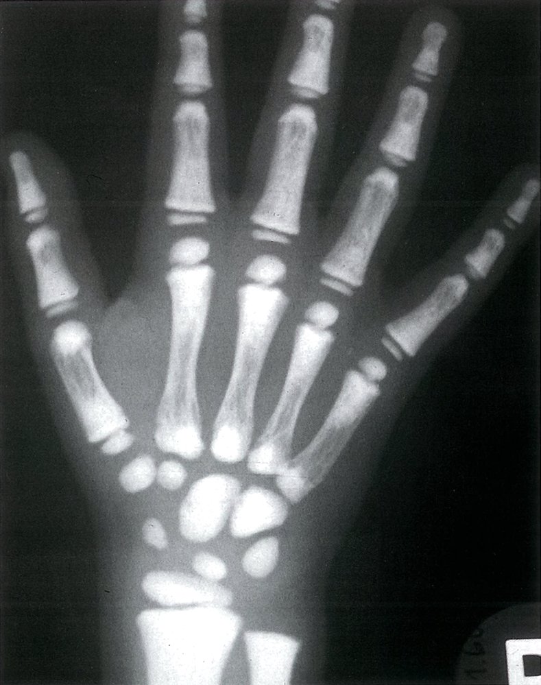 Osteopetrosis