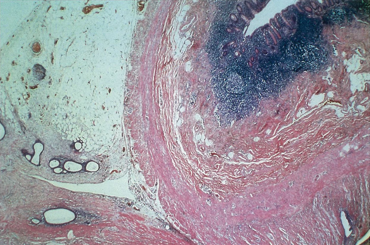 Endometriosis of the appendix