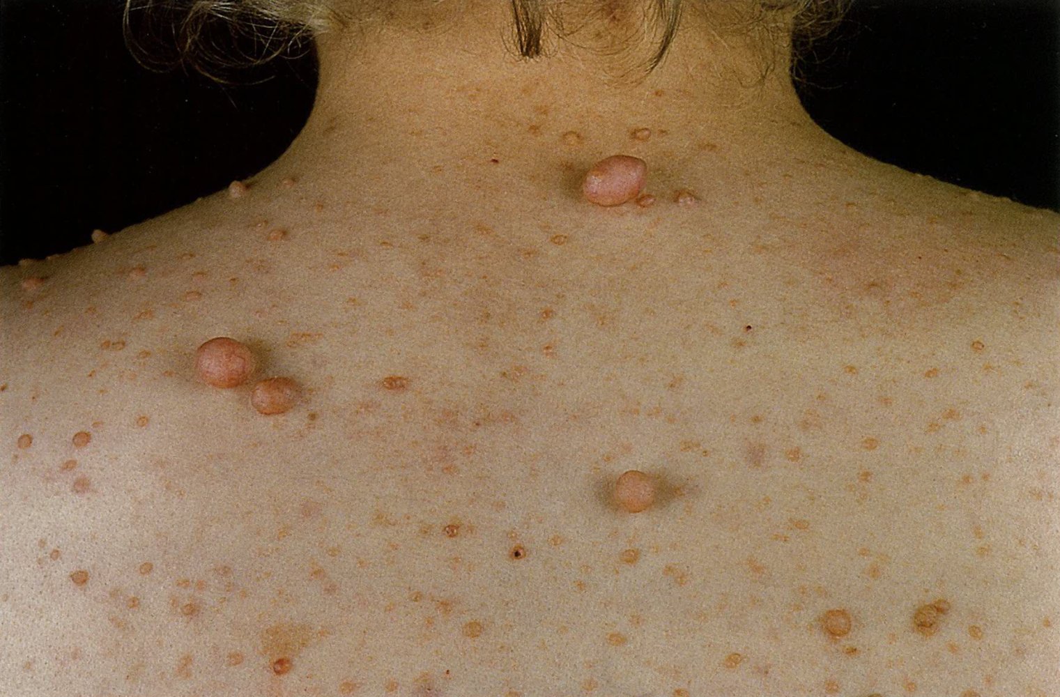 Neurofibromas