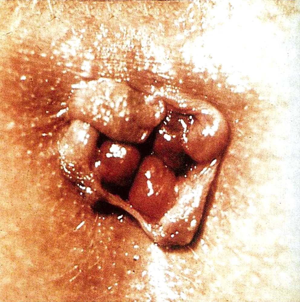 Grade III hemorrhoids and anal skin tags