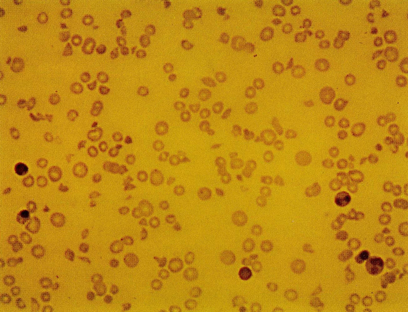 Schistocytes in hemolytic uremic syndrome