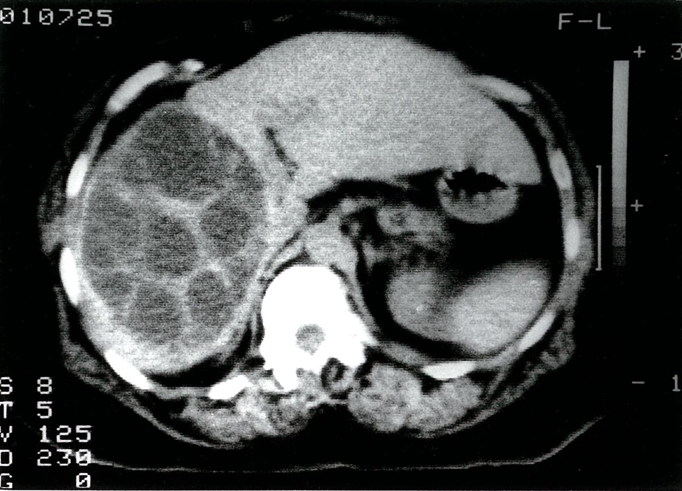 Echinococcosis