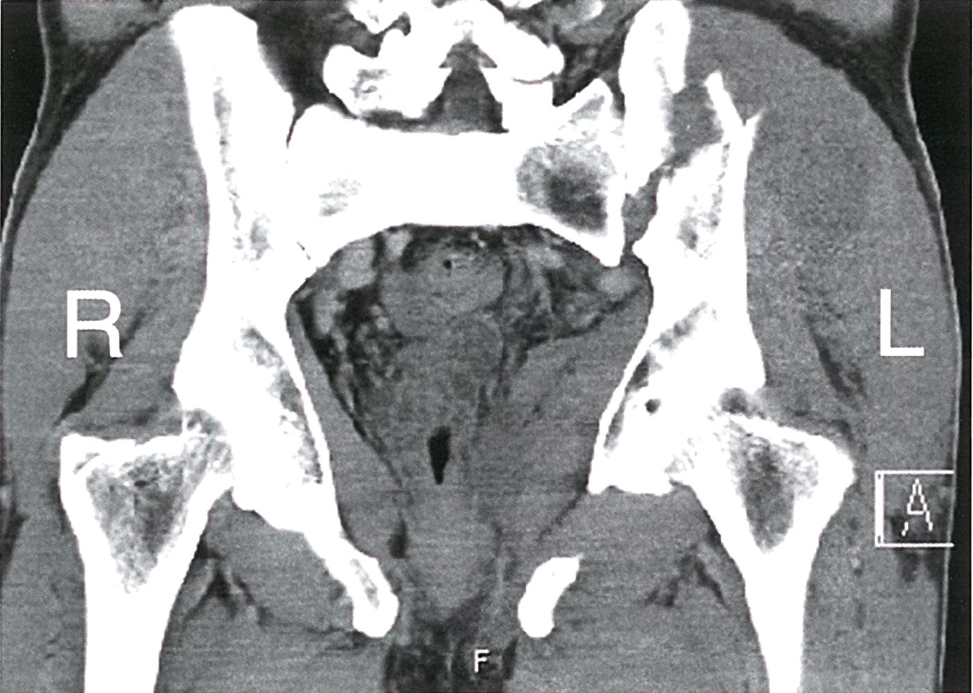 Left iliac wing fracture