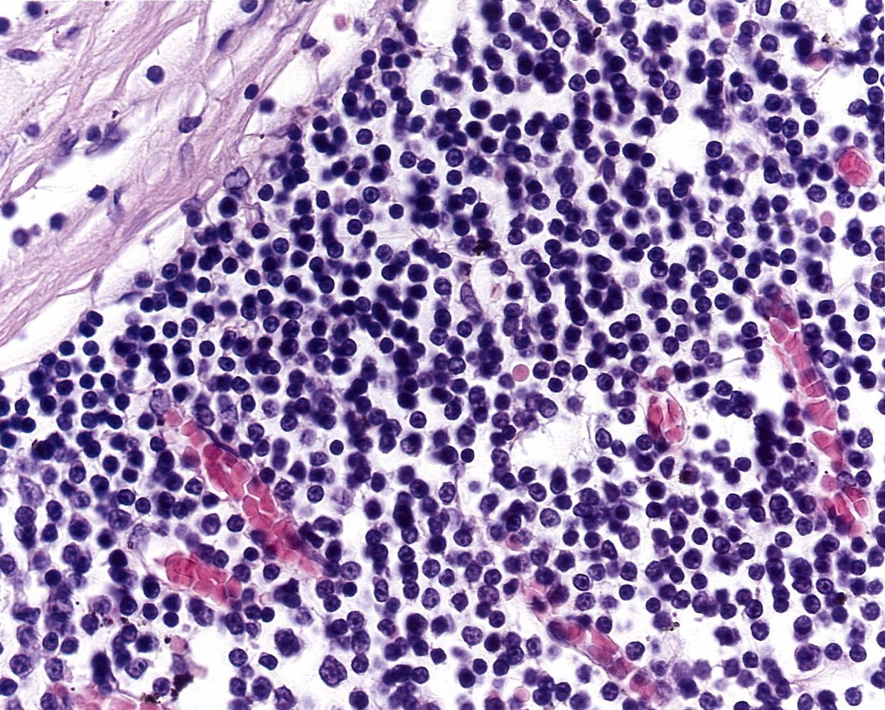 Chronic lymphocytic leukemia (CLL)