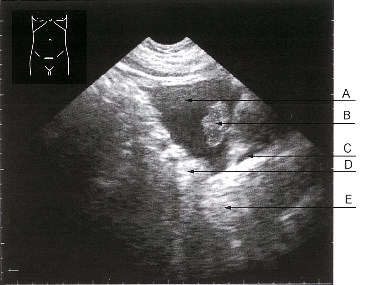 Ultrasound of the bladder in urothelial carcinoma