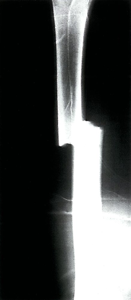 Displaced femoral fracture