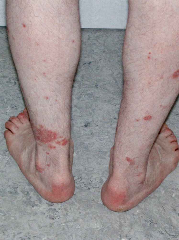 Enthesitis