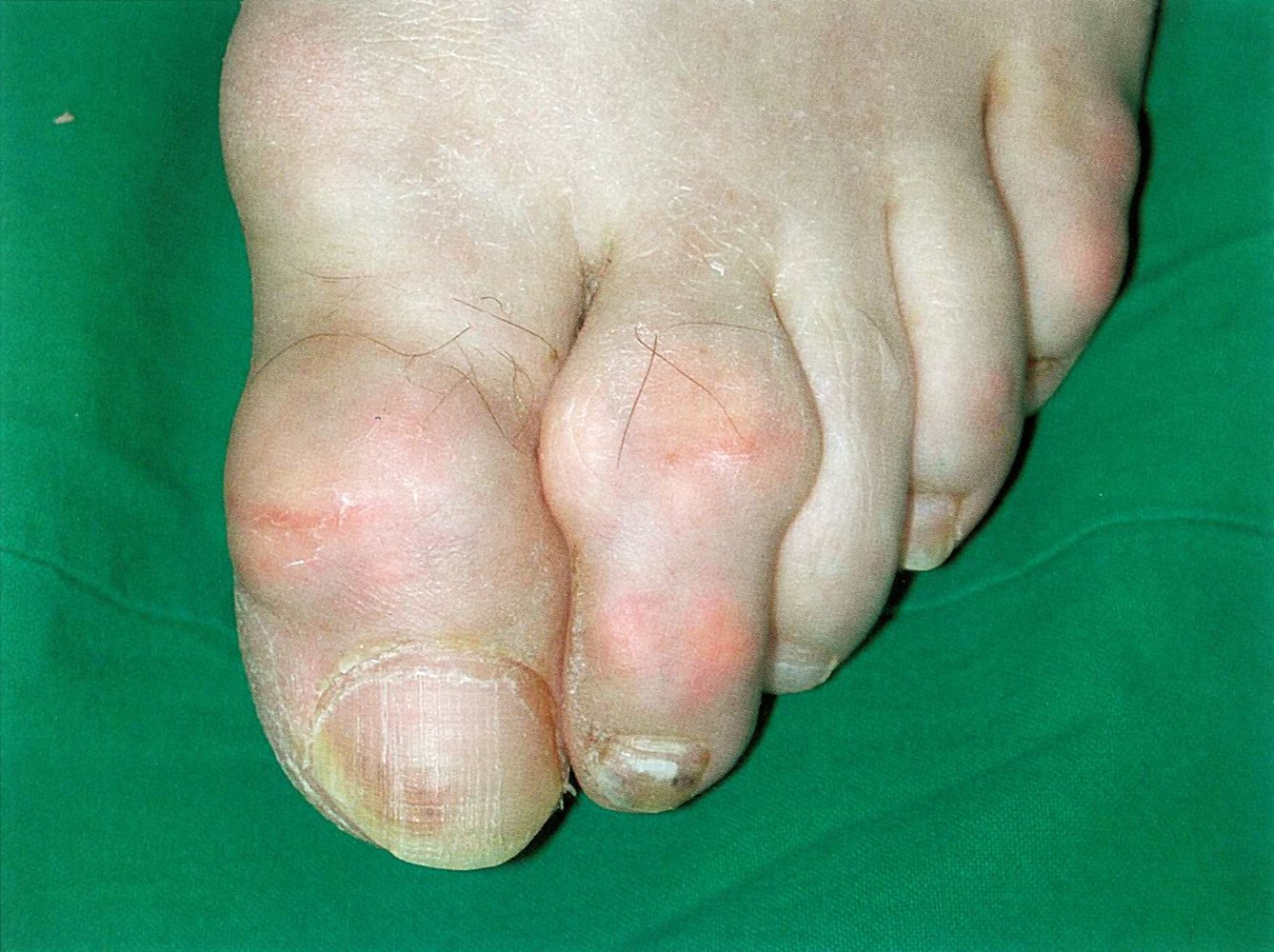 Gouty tophi due to urate crystal deposition in bones and soft tissues