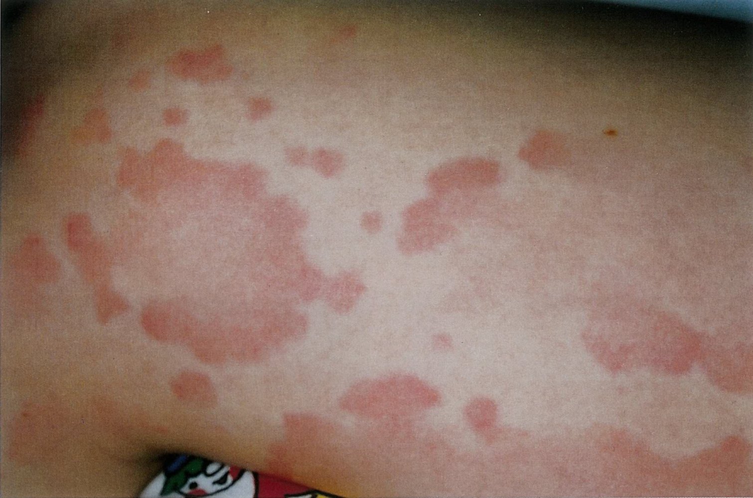 Erythematous lesions in erythema multiforme