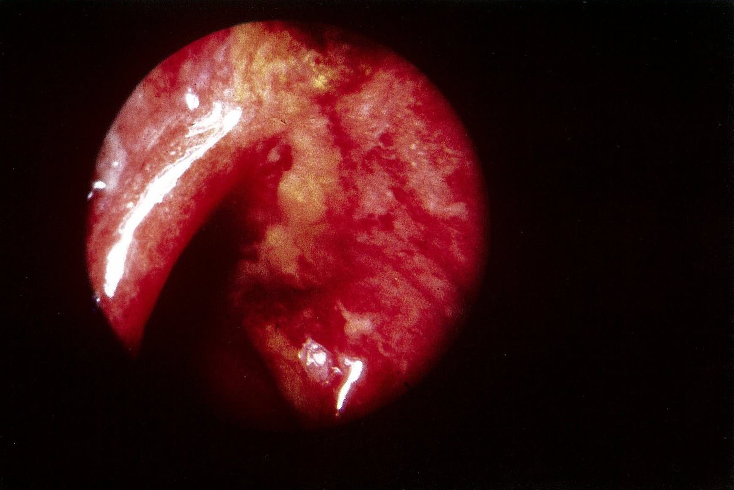 Ulcerative colitis