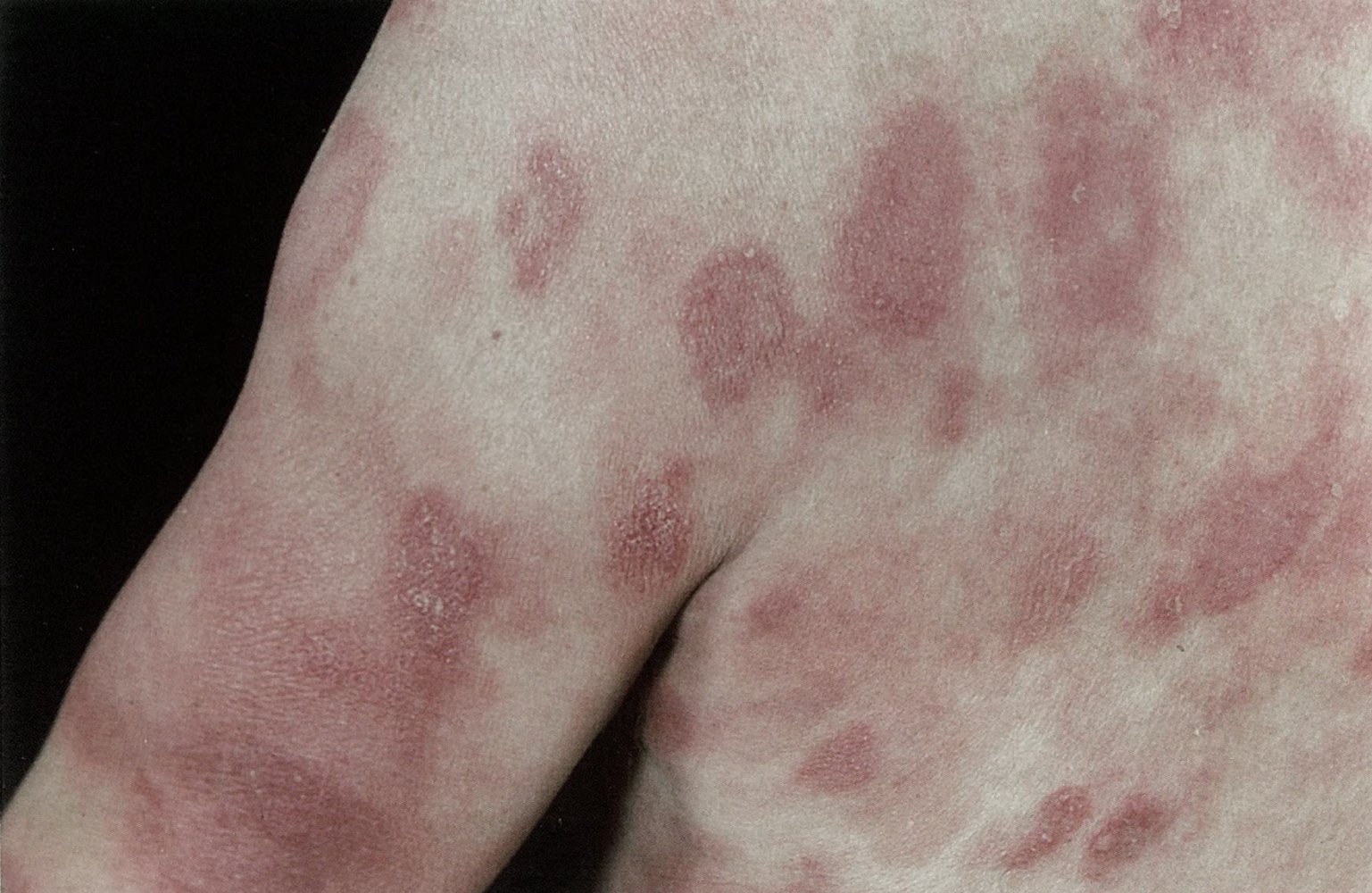 Mycosis fungoides