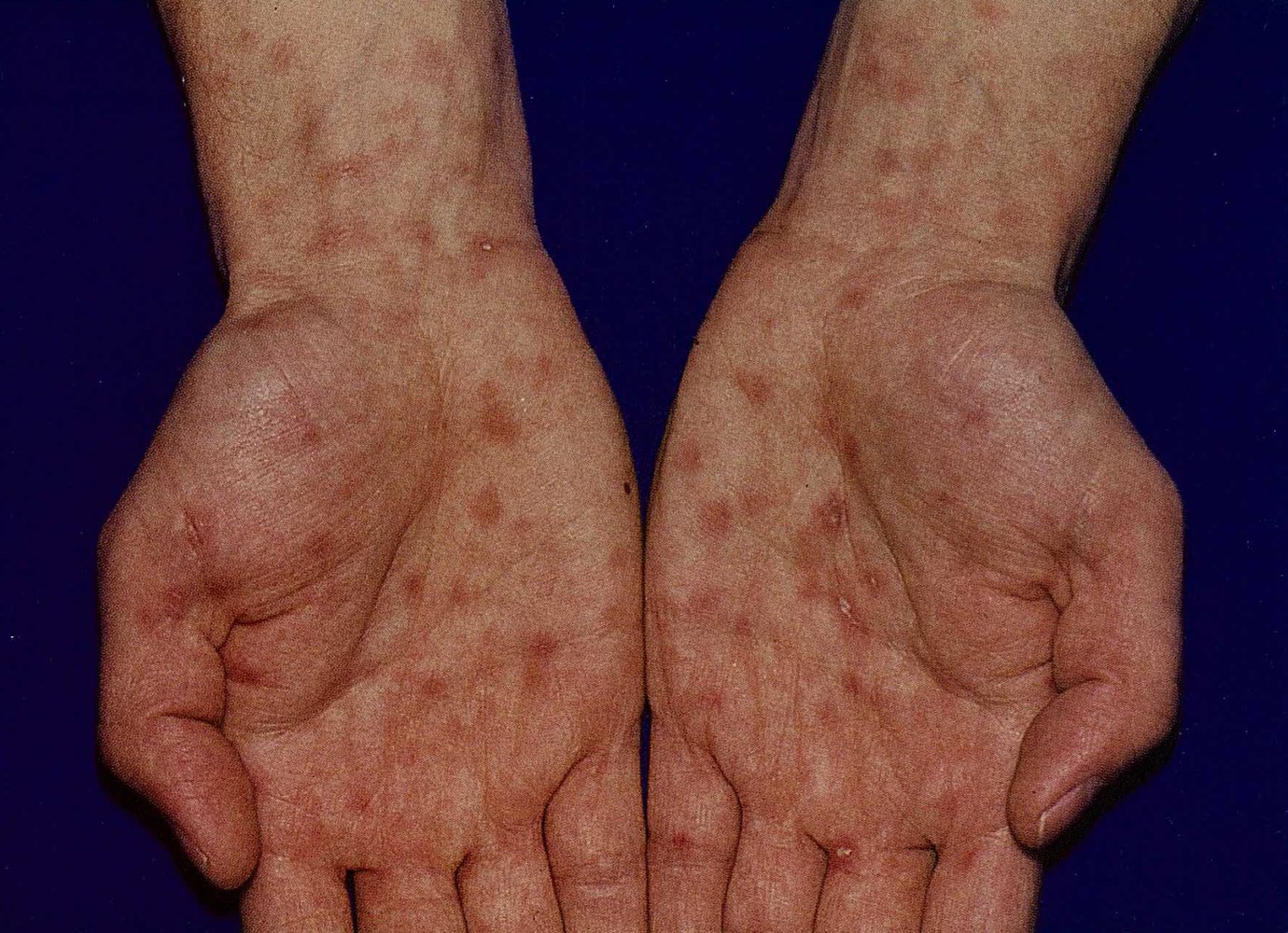 Maculopapular rash in secondary syphilis
