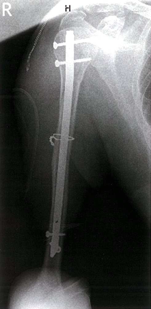 Humeral shaft fracture after intramedullary nail fixation