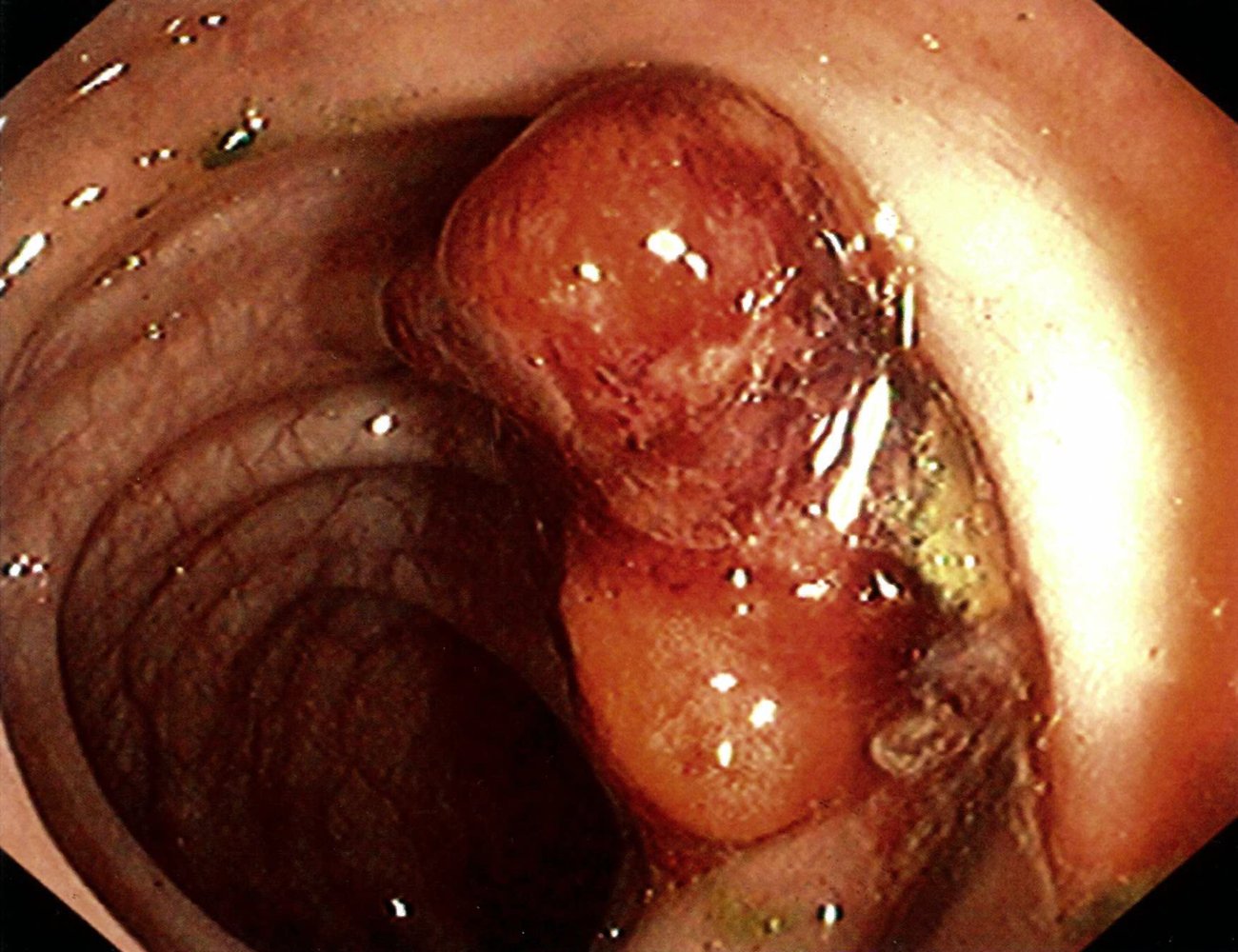 Colon cancer