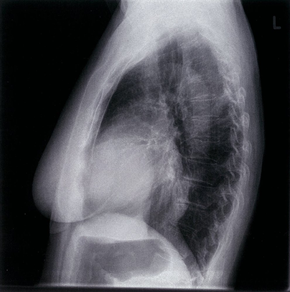Pericardial effusion