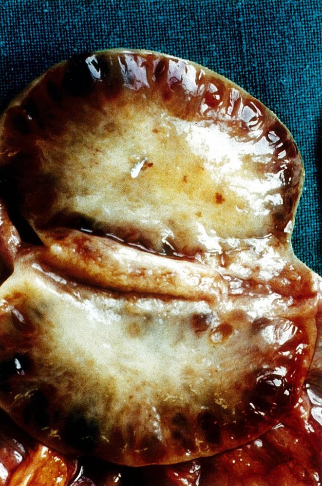 Polycystic ovary syndrome (PCOS; Stein-Leventhal syndrome)