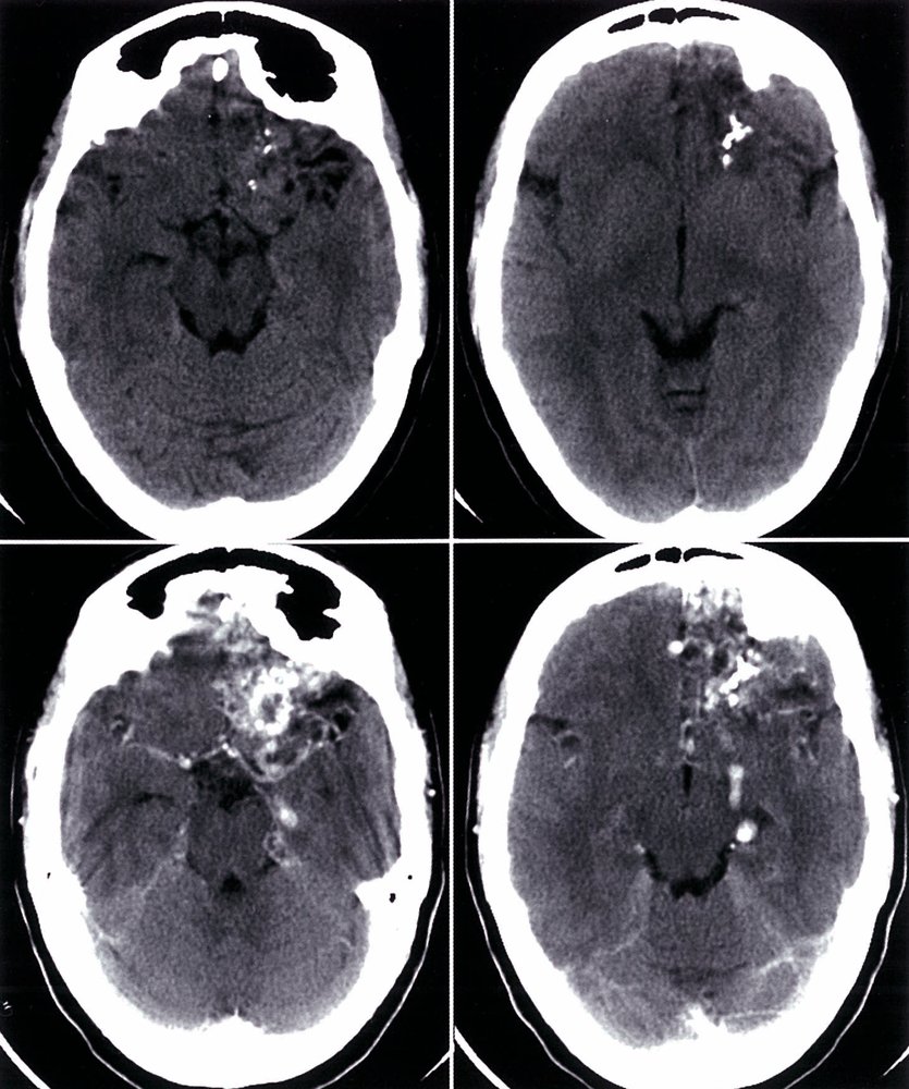 Arteriovenous malformation