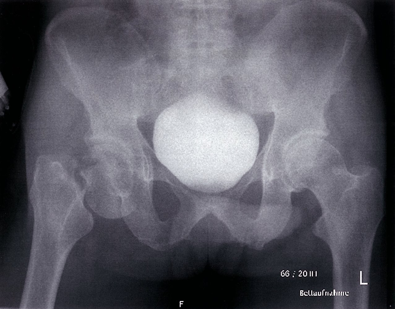 Fracture dislocation of the femoral head with a medial fracture of the femoral neck