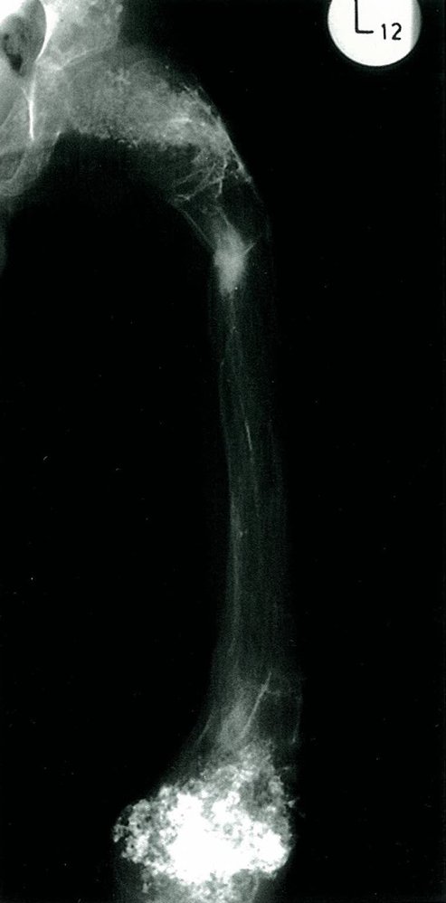 Enchondroma (enchondromatosis)