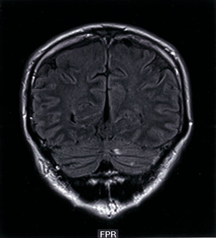 Hyperintense lesions in cerebellar infarction
