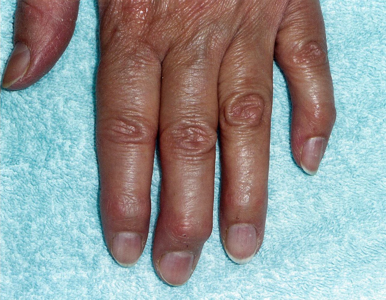 Heberden nodes
