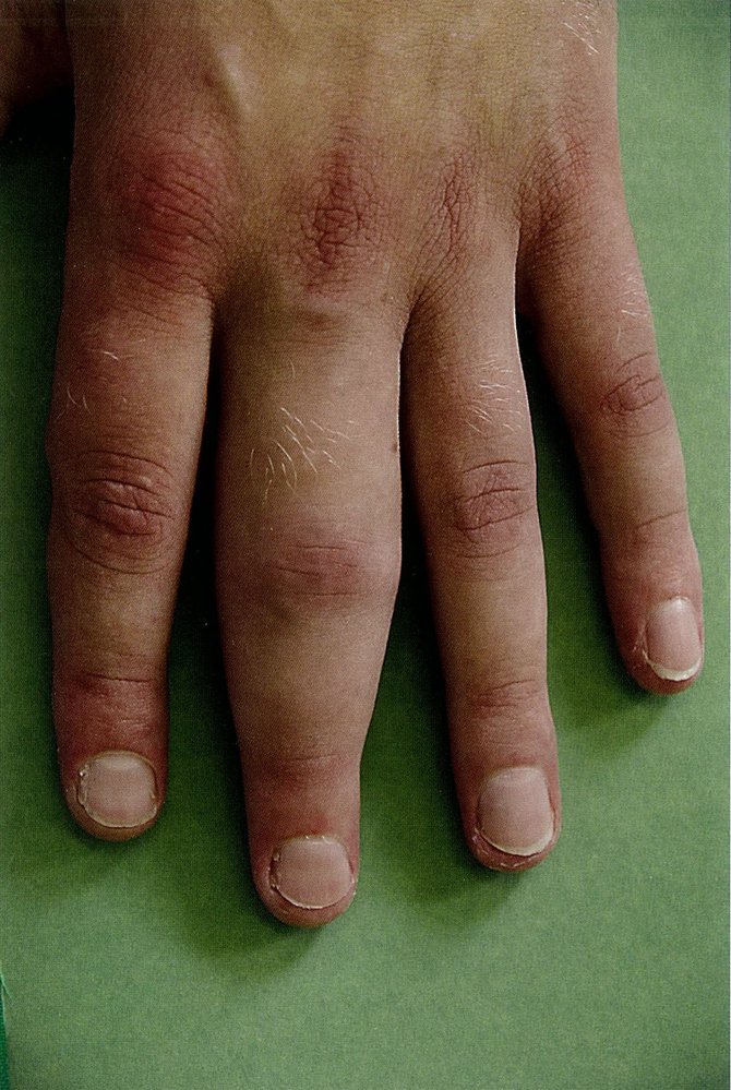 Monoarthritis in acute gouty arthritis