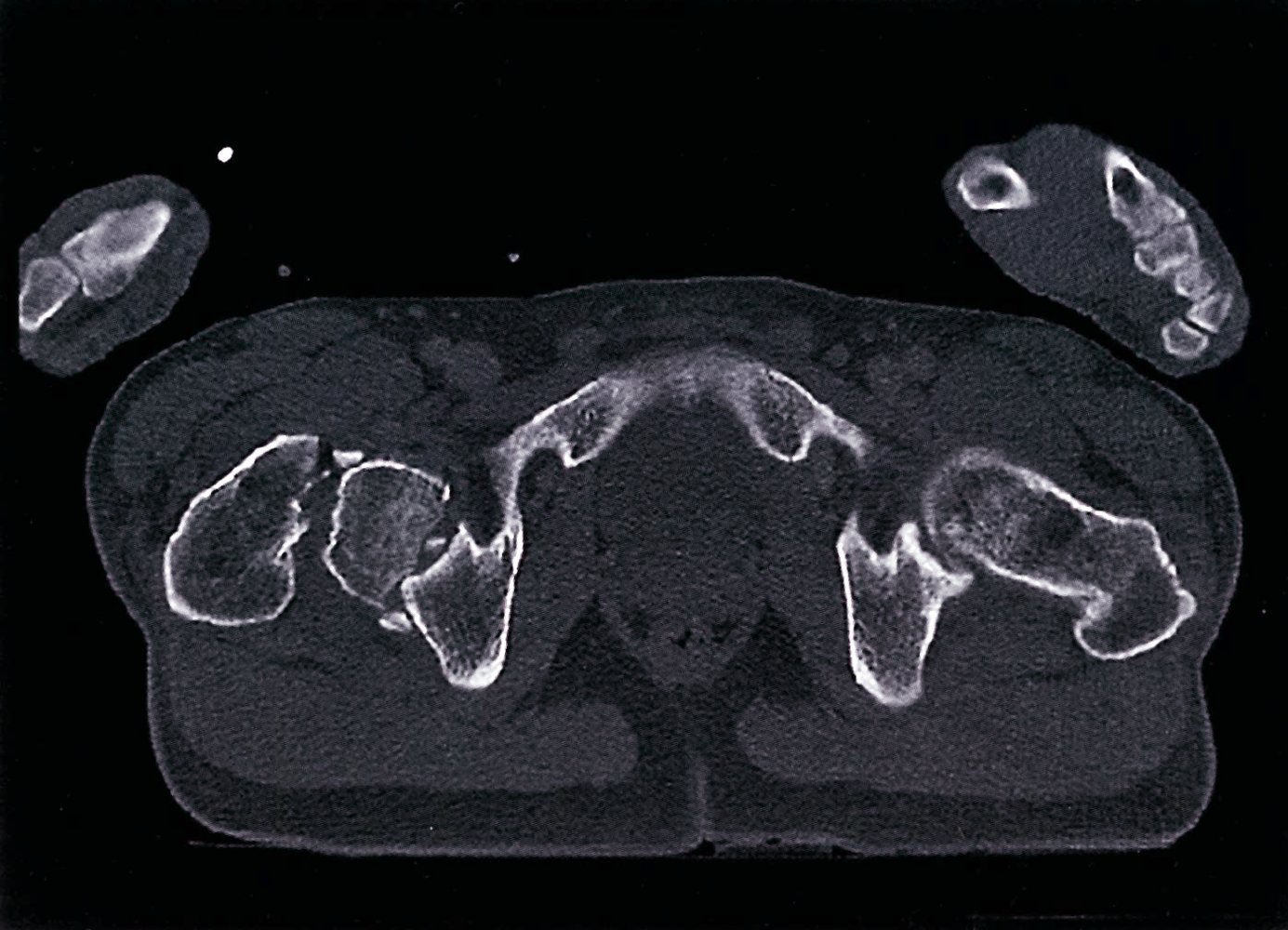 Fracture dislocation of the femoral head