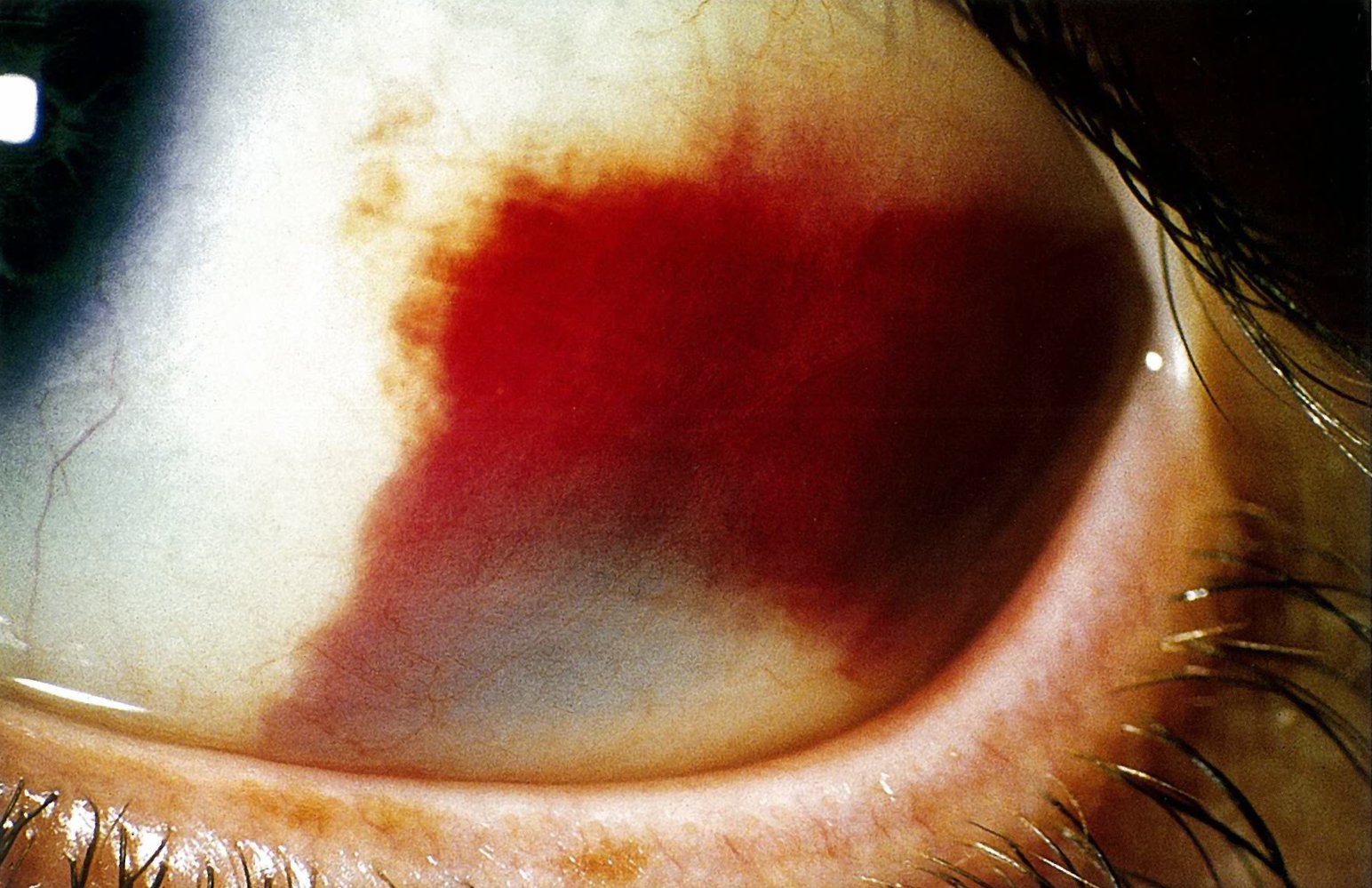 Subconjunctival hemorrhage