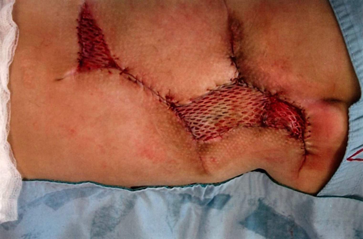 Mesh graft